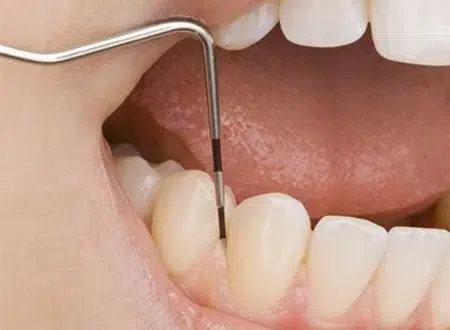 Comprehensive Dental Services – DentalQ Downtown Chicago Close-up of a dental examination using a periodontal probe to assess gum health.